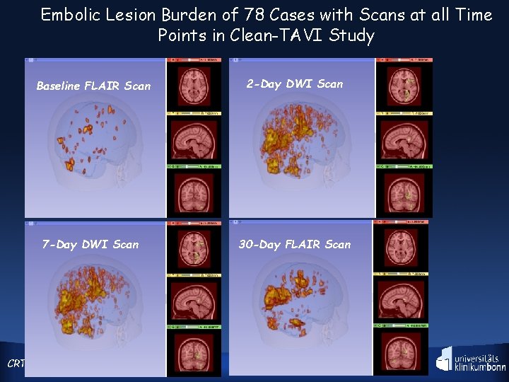 Embolic Lesion Burden of 78 Cases with Scans at all Time Points in Clean-TAVI