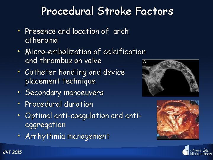 Procedural Stroke Factors • Presence and location of arch atheroma • Micro-embolization of calcification