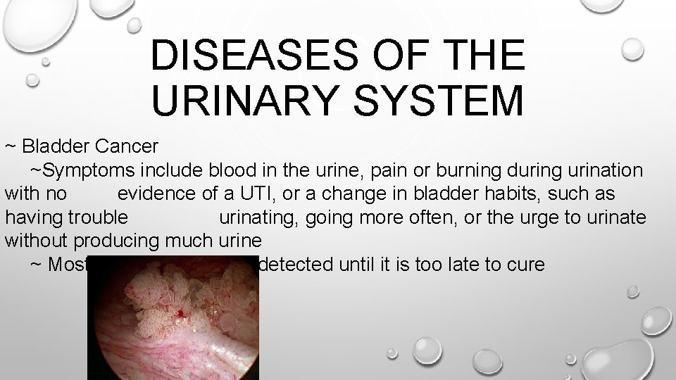 DISEASES OF THE URINARY SYSTEM ~ Bladder Cancer ~Symptoms include blood in the urine,