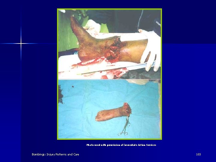 Photo used with permission of Immediate Action Services Bombings: Injury Patterns and Care 103