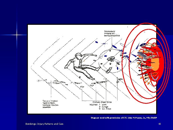Diagram used with permission of LTC John Mc. Manus, Jr. , MD, FACEP Bombings: