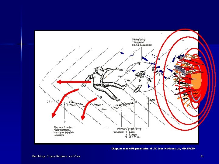 Diagram used with permission of LTC John Mc. Manus, Jr. , MD, FACEP Bombings: