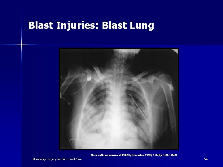 Blast Injuries: Blast Lung Used with permission of CHEST, December 1999; 116(6): 1683 -1688