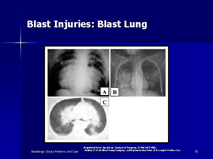 Blast Injuries: Blast Lung Bombings: Injury Patterns and Care Reprinted from American Journal of