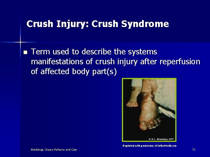 Crush Injury: Crush Syndrome n Term used to describe the systems manifestations of crush