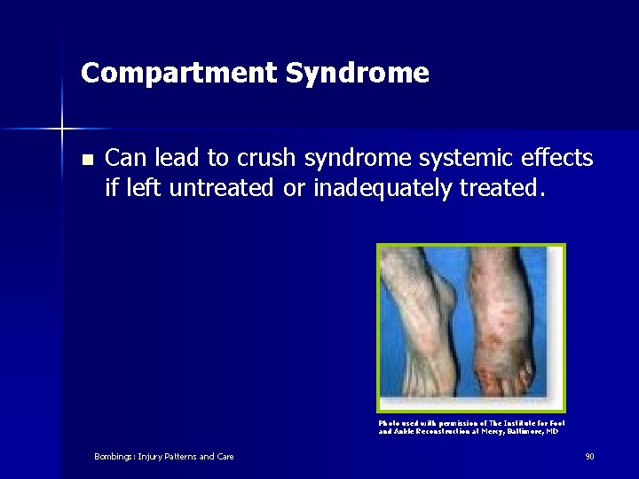 Compartment Syndrome n Can lead to crush syndrome systemic effects if left untreated or