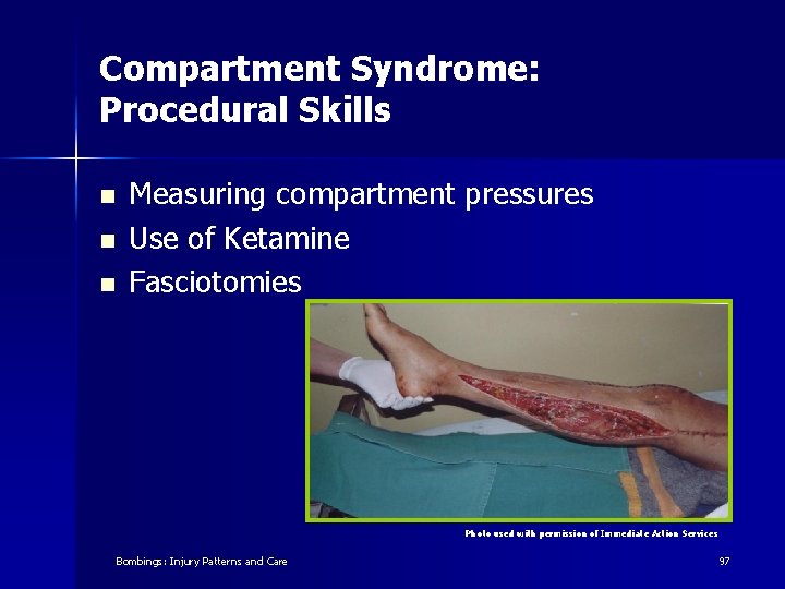 Compartment Syndrome: Procedural Skills n n n Measuring compartment pressures Use of Ketamine Fasciotomies