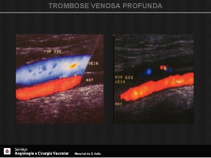 TROMBOSE VENOSA PROFUNDA 
