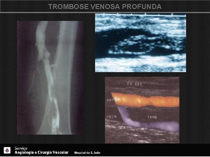 TROMBOSE VENOSA PROFUNDA 