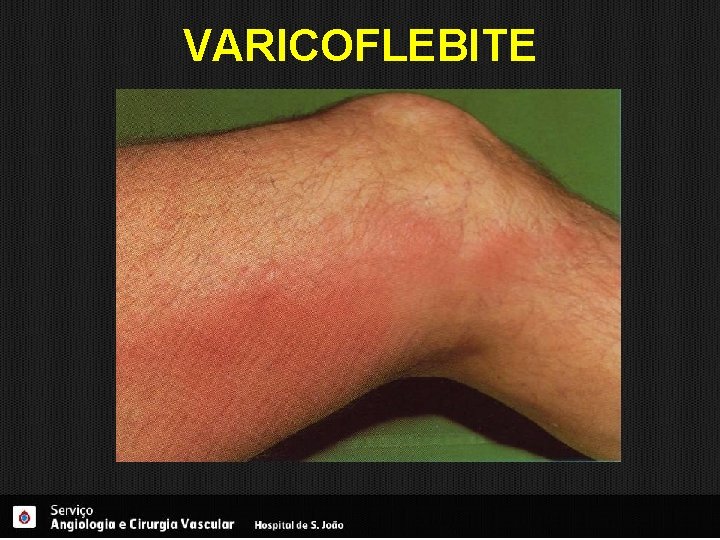 VARICOFLEBITE 