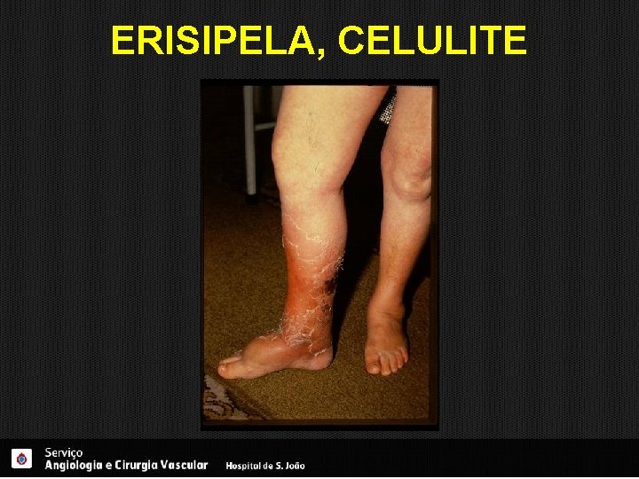 ERISIPELA, CELULITE 
