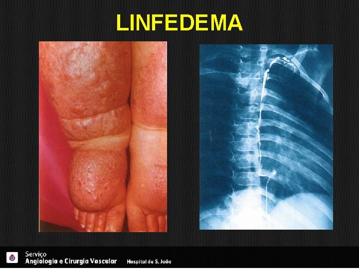 LINFEDEMA 