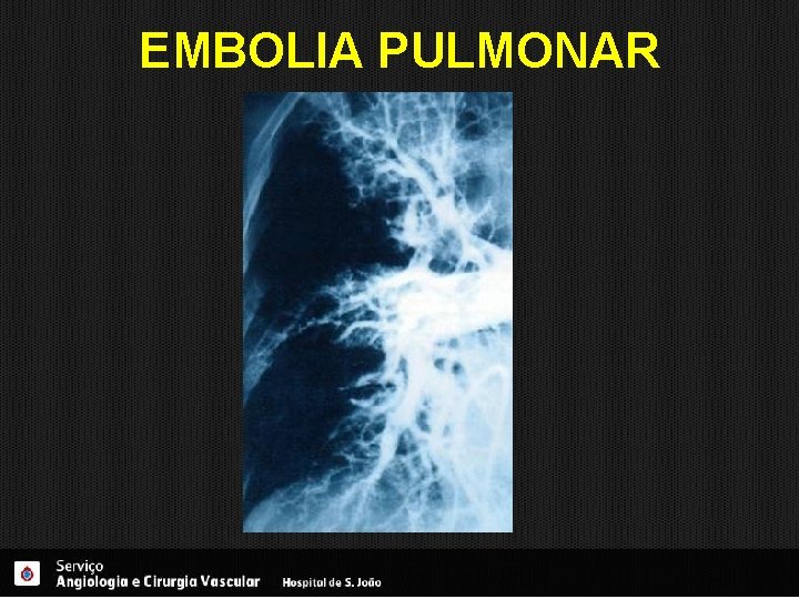 EMBOLIA PULMONAR 