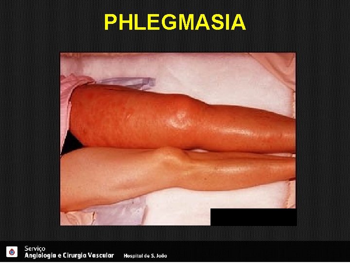 PHLEGMASIA 