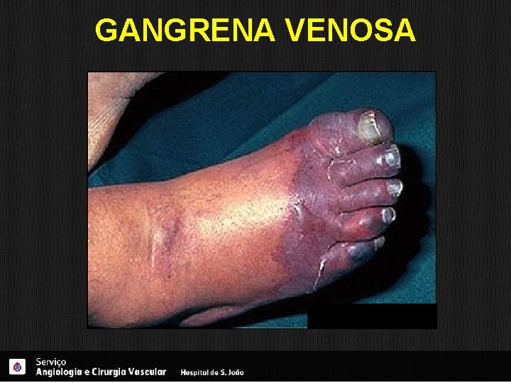GANGRENA VENOSA 