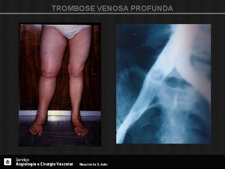 TROMBOSE VENOSA PROFUNDA 