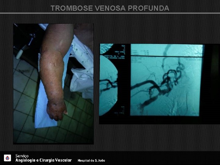 TROMBOSE VENOSA PROFUNDA 