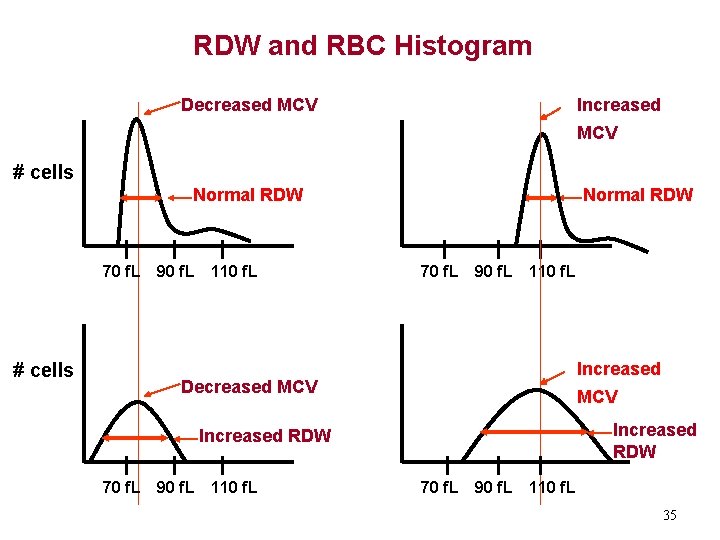 RDW and RBC Histogram Decreased MCV Increased MCV # cells Normal RDW 70 f.