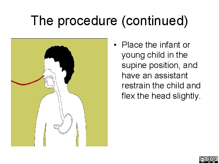 The procedure (continued) • Place the infant or young child in the supine position,