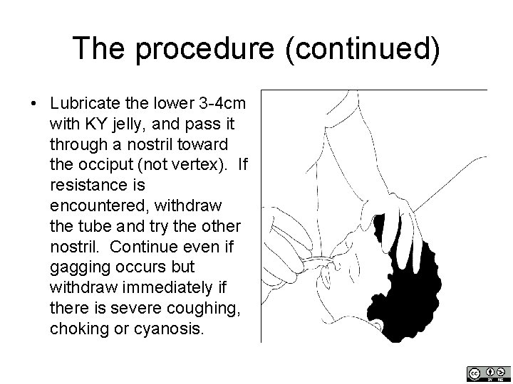 The procedure (continued) • Lubricate the lower 3 -4 cm with KY jelly, and