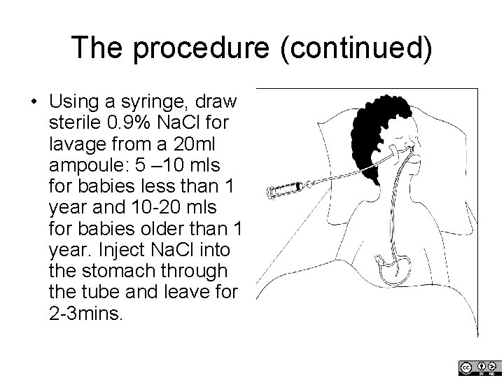 The procedure (continued) • Using a syringe, draw sterile 0. 9% Na. Cl for