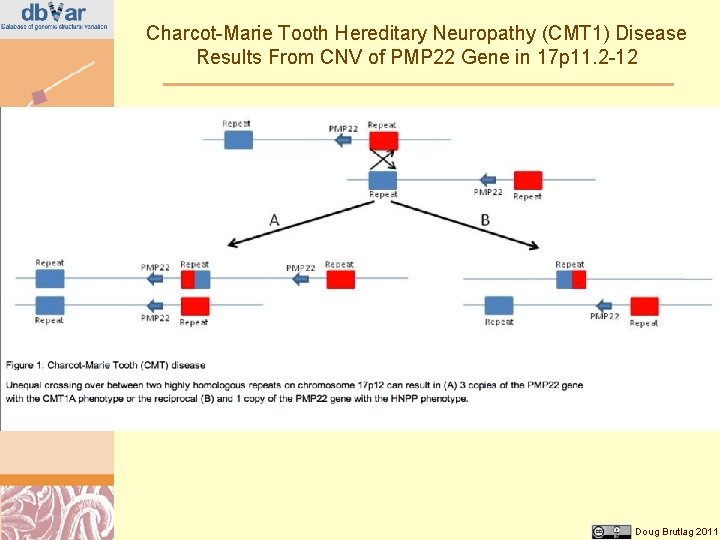 Charcot-Marie Tooth Hereditary Neuropathy (CMT 1) Disease Results From CNV of PMP 22 Gene
