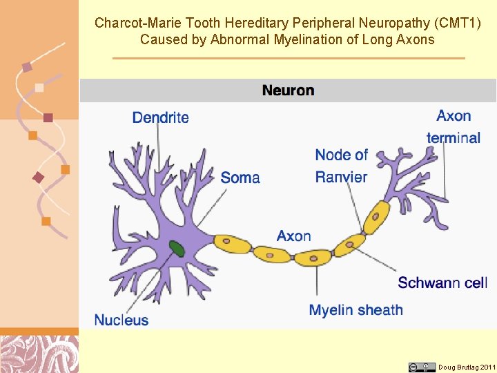 Charcot-Marie Tooth Hereditary Peripheral Neuropathy (CMT 1) Caused by Abnormal Myelination of Long Axons