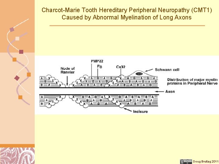 Charcot-Marie Tooth Hereditary Peripheral Neuropathy (CMT 1) Caused by Abnormal Myelination of Long Axons