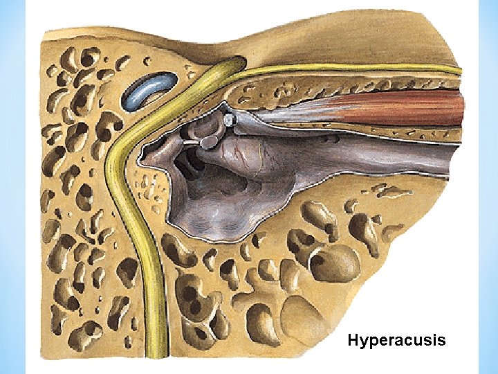 Hyperacusis 