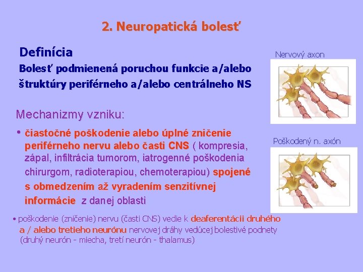 2. Neuropatická bolesť Definícia Nervový axon Bolesť podmienená poruchou funkcie a/alebo štruktúry periférneho a/alebo