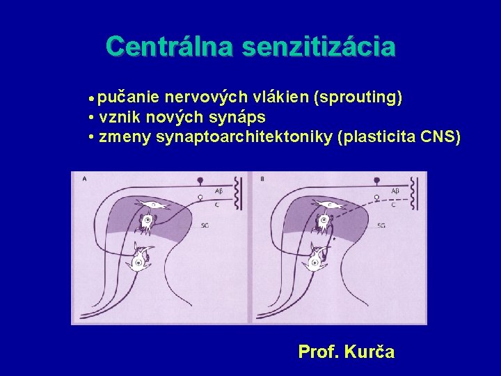 Centrálna senzitizácia pučanie nervových vlákien (sprouting) • vznik nových synáps • zmeny synaptoarchitektoniky (plasticita