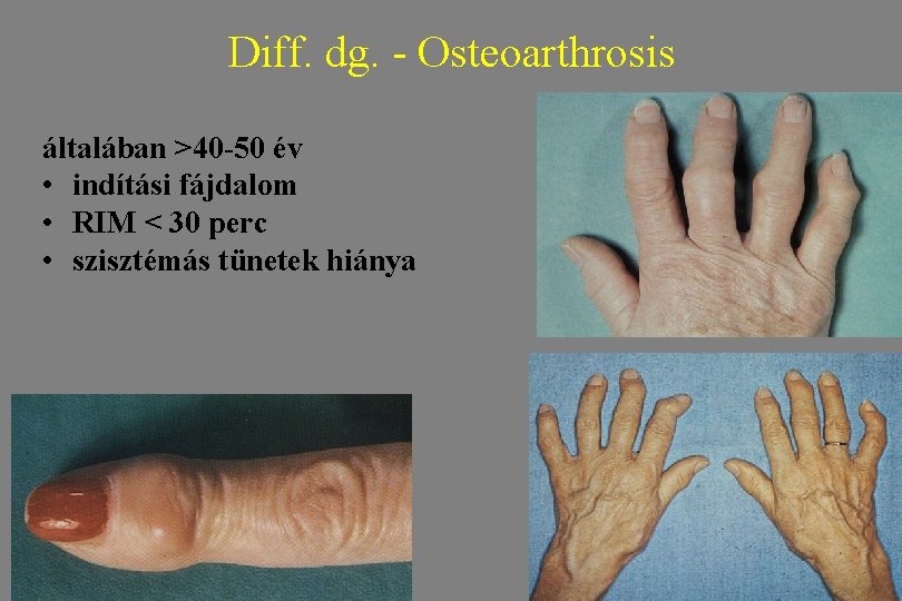 Diff. dg. - Osteoarthrosis általában >40 -50 év • indítási fájdalom • RIM <
