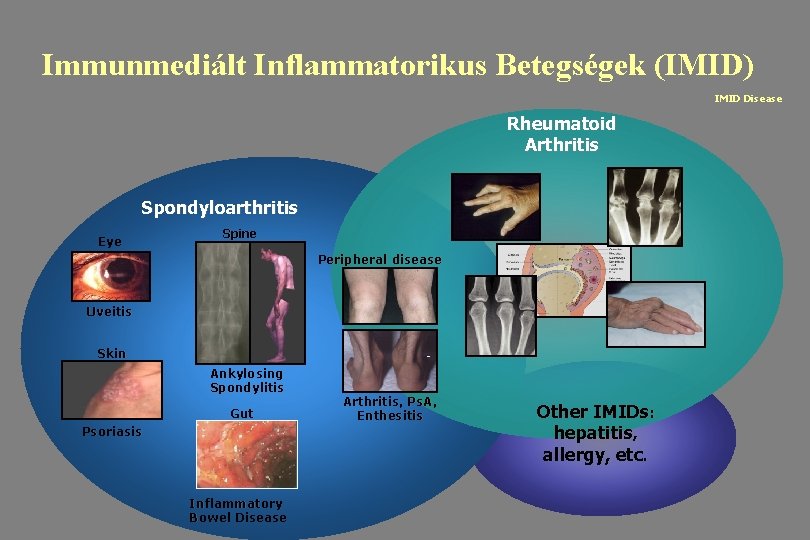 Immunmediált Inflammatorikus Betegségek (IMID) IMID Disease Rheumatoid Arthritis Spondyloarthritis Eye Spine Peripheral disease Uveitis