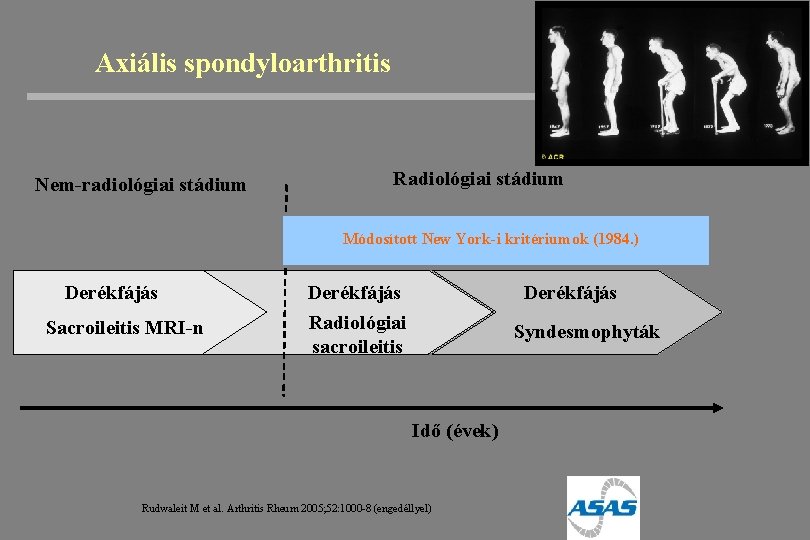 Axiális spondyloarthritis Nem-radiológiai stádium Radiológiai stádium Módosított New York-i kritériumok (1984. ) Derékfájás Sacroileitis