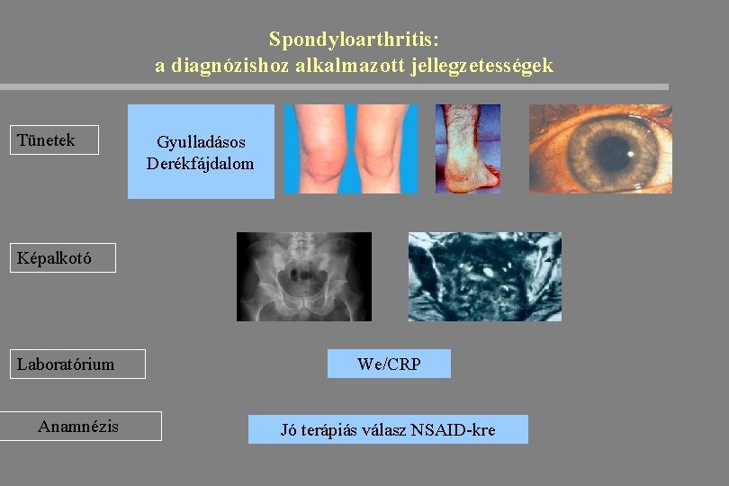 Spondyloarthritis: a diagnózishoz alkalmazott jellegzetességek Tünetek Gyulladásos Derékfájdalom Képalkotó Laboratórium Anamnézis We/CRP Jó terápiás