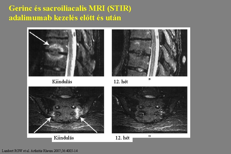 Gerinc és sacroiliacalis MRI (STIR) adalimumab kezelés előtt és után Kiindulás Lambert RGW et