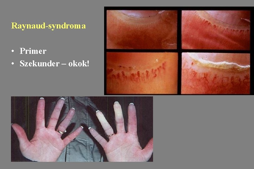 Raynaud-syndroma • Primer • Szekunder – okok! 