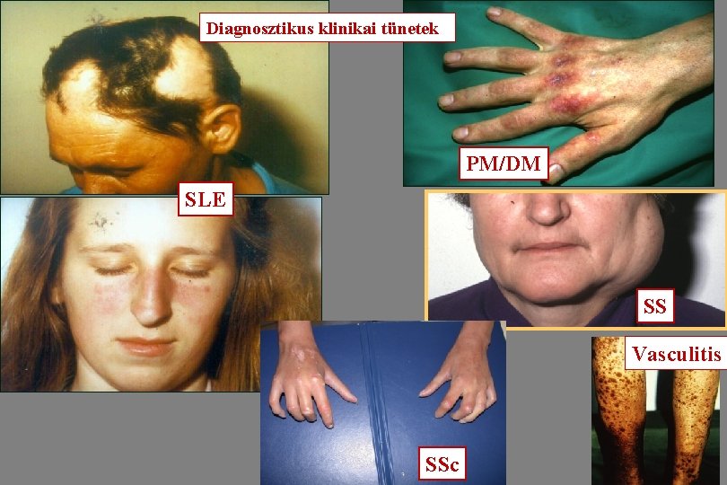 Diagnosztikus klinikai tünetek PM/DM SLE SS Vasculitis SSc 