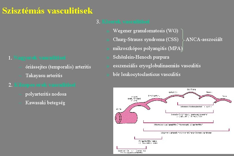 Szisztémás vasculitisek 3. Kiserek vasculitisei » Wegener granulomatosis (WG) » Churg-Strauss syndroma (CSS) ANCA-asszociált