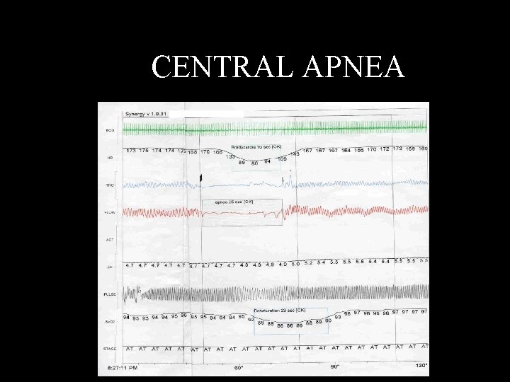 CENTRAL APNEA 