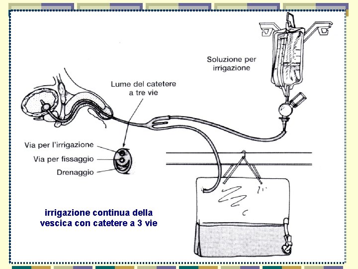 irrigazione continua della vescica con catetere a 3 vie 22 