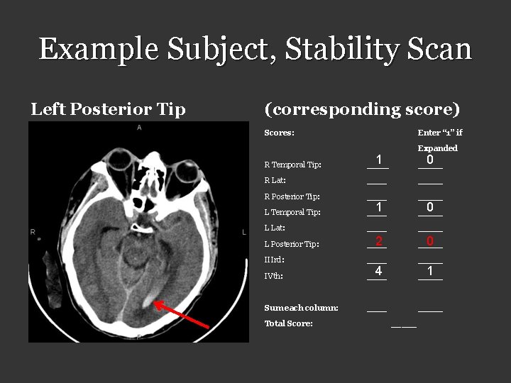 Example Subject, Stability Scan Left Posterior Tip (corresponding score) Scores: Enter “ 1” if