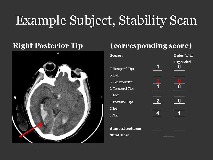 Example Subject, Stability Scan Right Posterior Tip (corresponding score) Scores: Enter “ 1” if