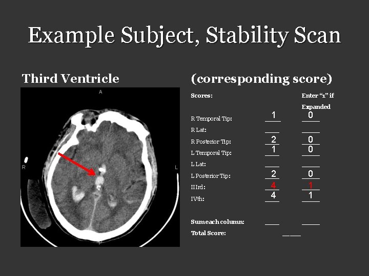 Example Subject, Stability Scan Third Ventricle (corresponding score) Scores: Enter “ 1” if Expanded