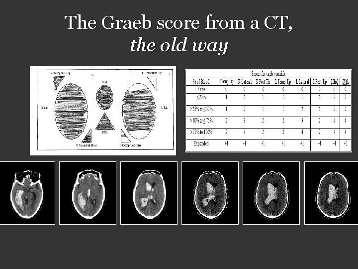 The Graeb score from a CT, the old way 