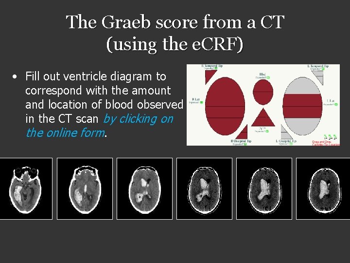 The Graeb score from a CT (using the e. CRF) • Fill out ventricle