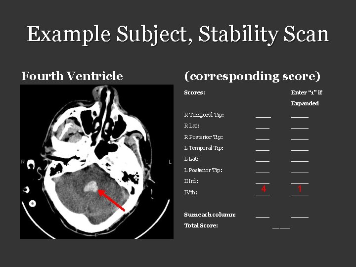 Example Subject, Stability Scan Fourth Ventricle (corresponding score) Scores: Enter “ 1” if Expanded