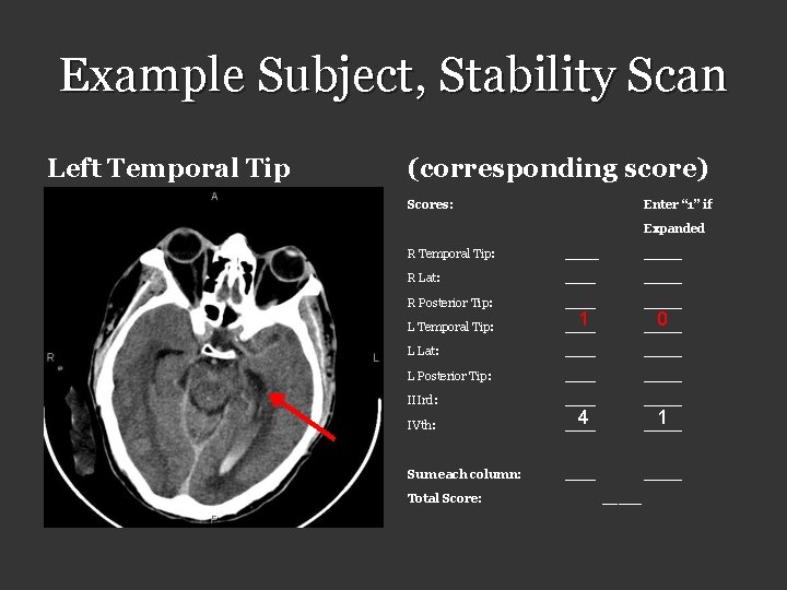 Example Subject, Stability Scan Left Temporal Tip (corresponding score) Scores: Enter “ 1” if