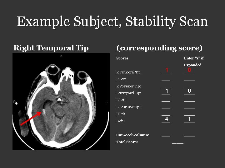 Example Subject, Stability Scan Right Temporal Tip (corresponding score) Scores: Enter “ 1” if