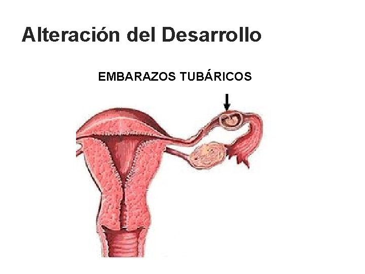 Alteración del Desarrollo EMBARAZOS TUBÁRICOS 